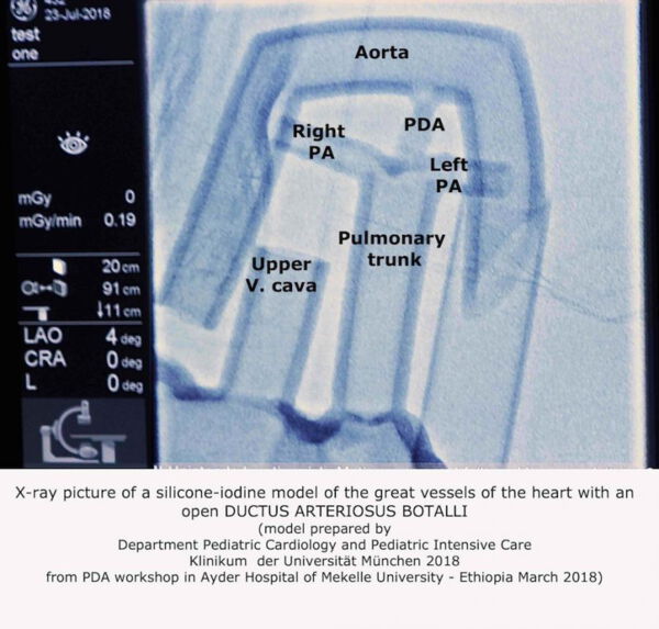 Heart simulator for PDA closure made by 3D printer from silicone and contrast media
