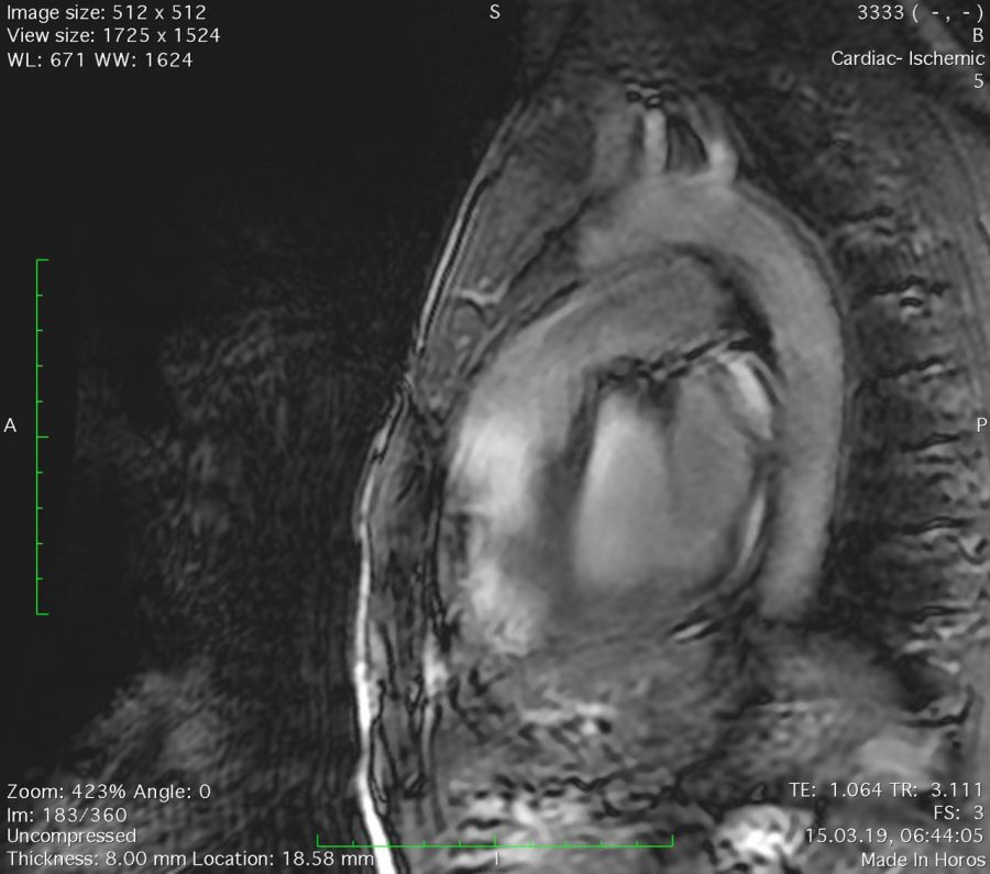 Cardia MRI vertical cut