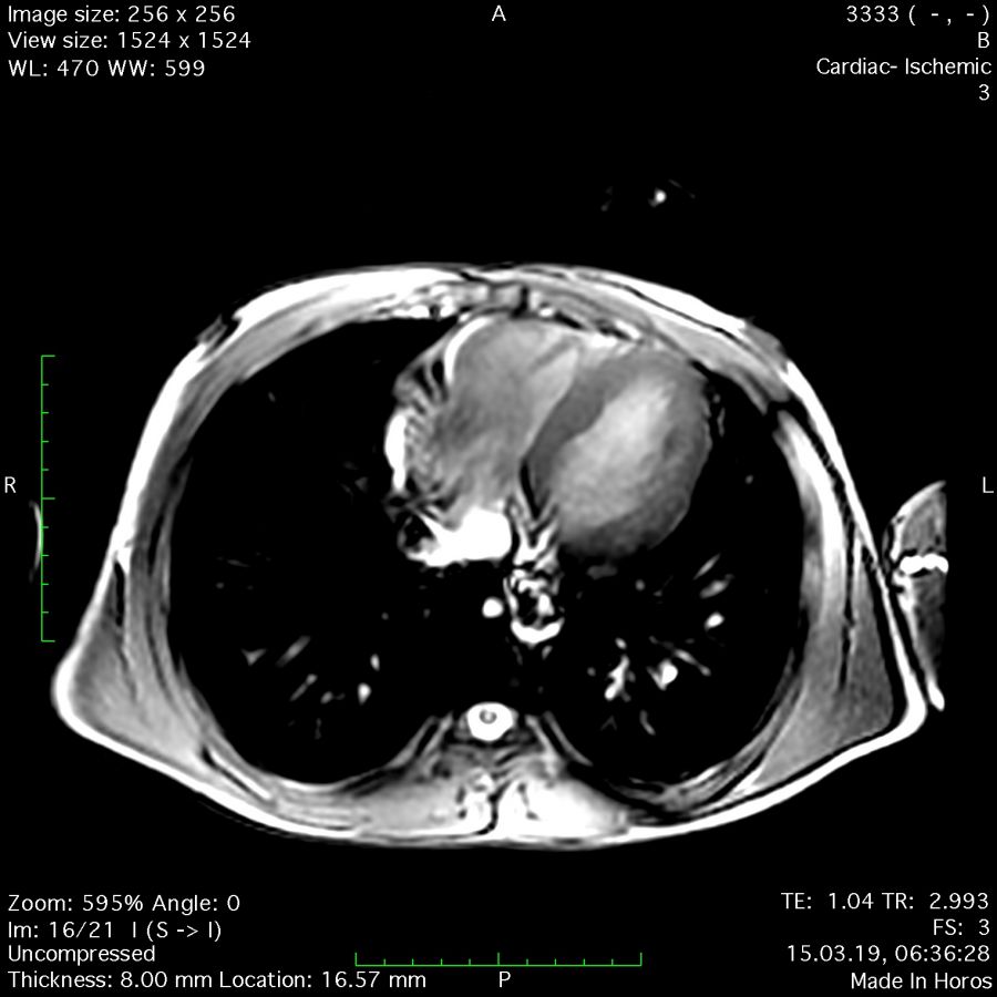 Cardiac MRI horizontal cut