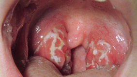 Sore throat  needs PrevRHD - Penicilling